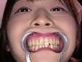 野こはるチャンの舌ベロ・歯・口内・のどちんこ観察